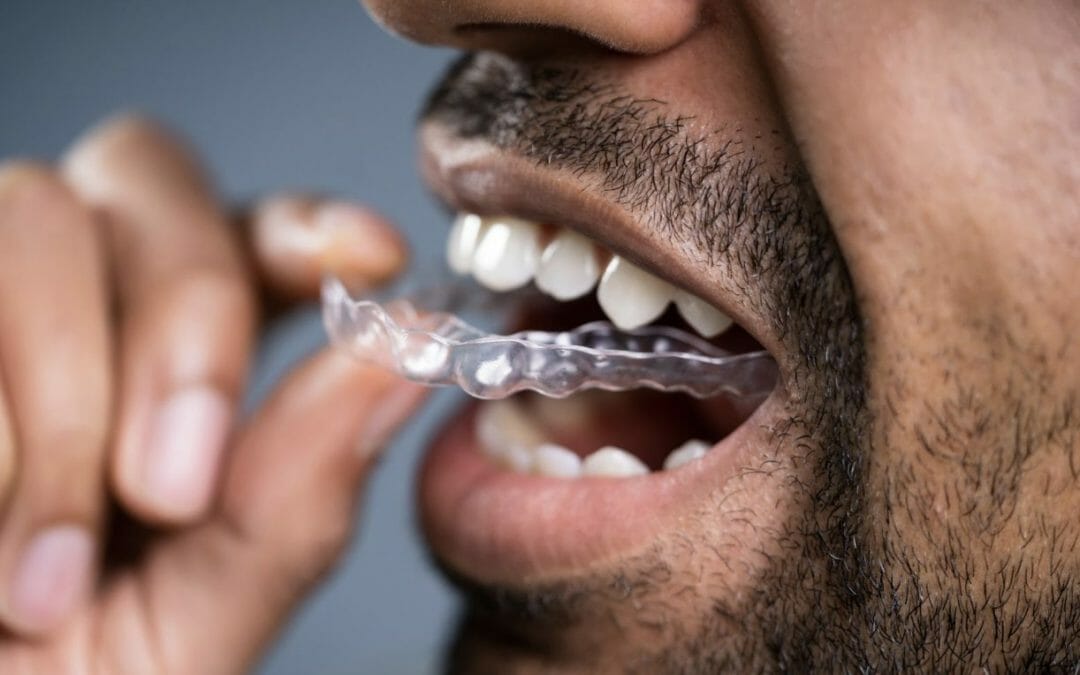 Nightguards for Bruxism Relief: Stop Grinding Your Teeth