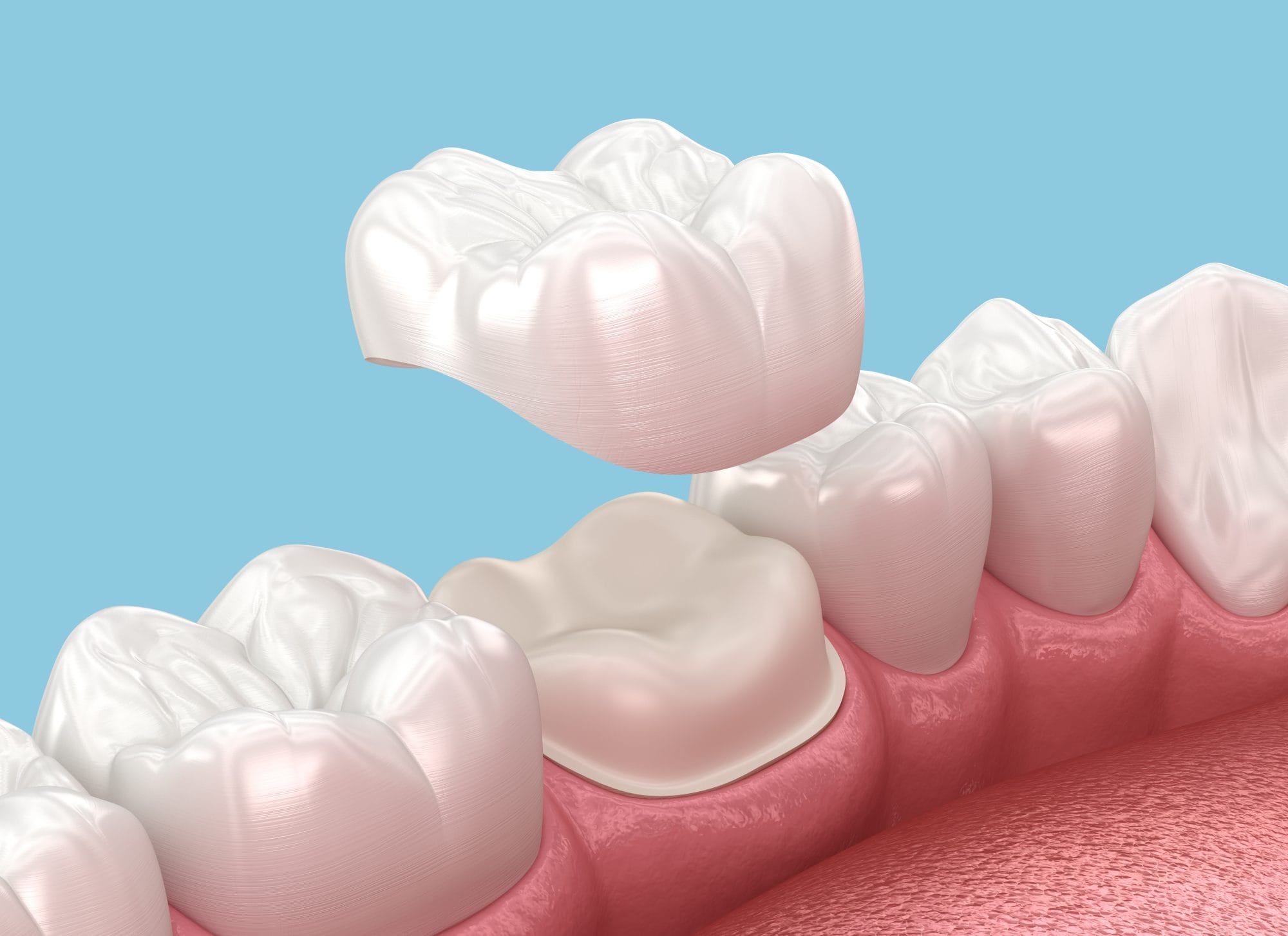 Everything You Need To Know About Dental Crowns Dentistry Of West Bend