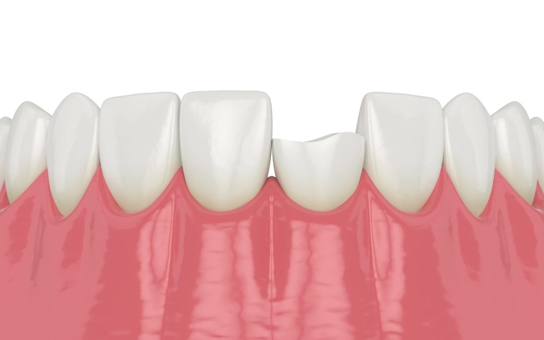 Tiny Rough Spot on Your Tooth? When a Small Chip, Old Filling, or Worn Edge Needs Attention