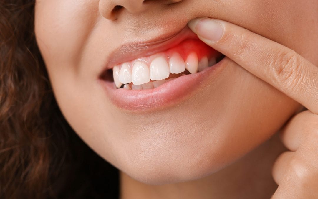Early gum disease Doesn’t Always Hurt. Here’s Why Timing Matters