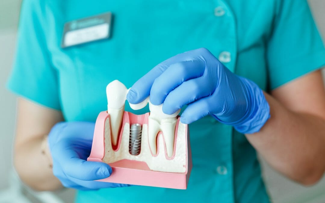 The Process of Getting Dental Implants: What to Expect