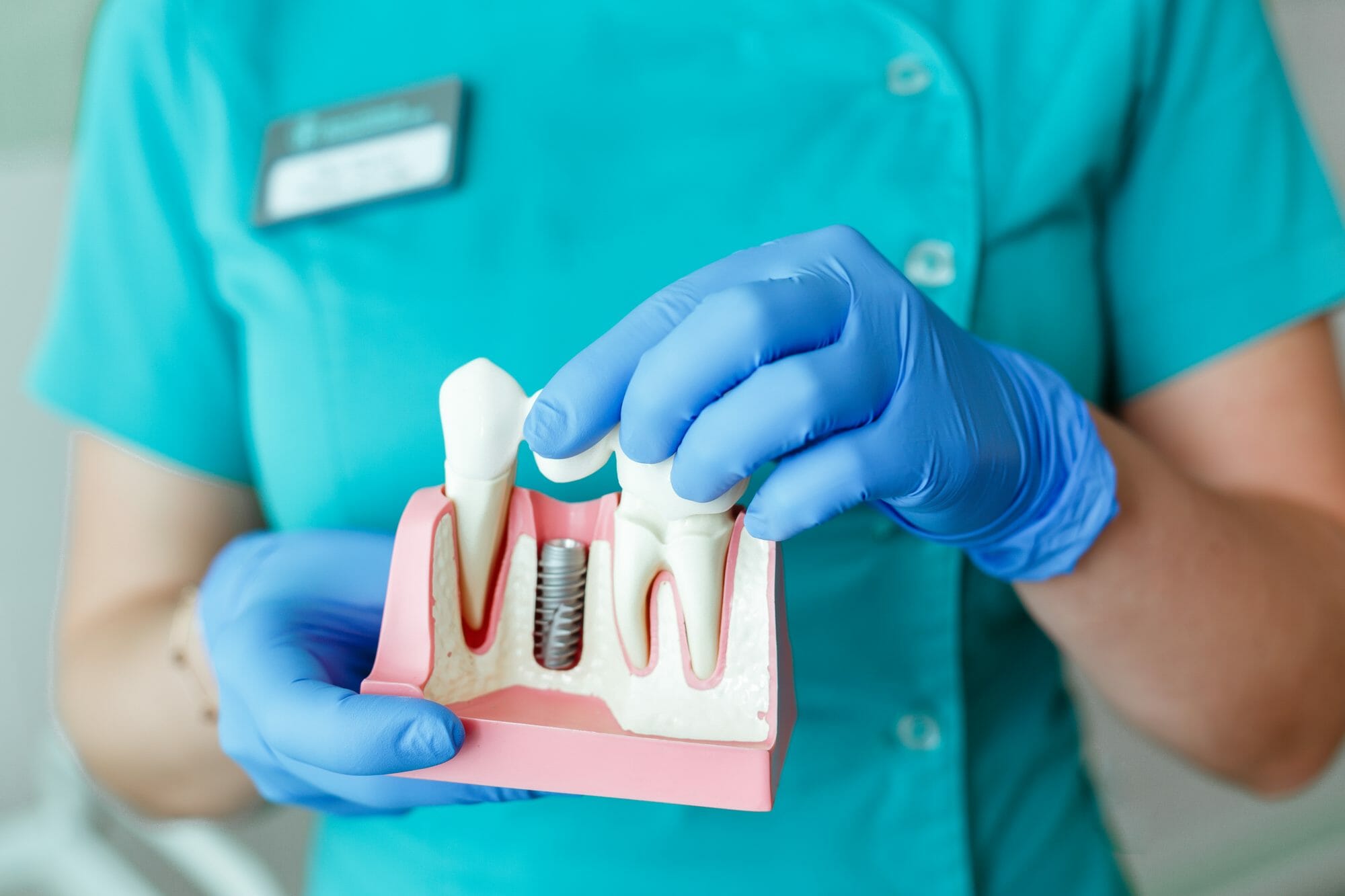 What to Expect With Getting Dental Implants