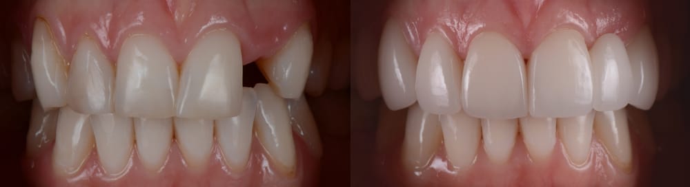Dental Bridges vs Dentures: Choosing the Best Option