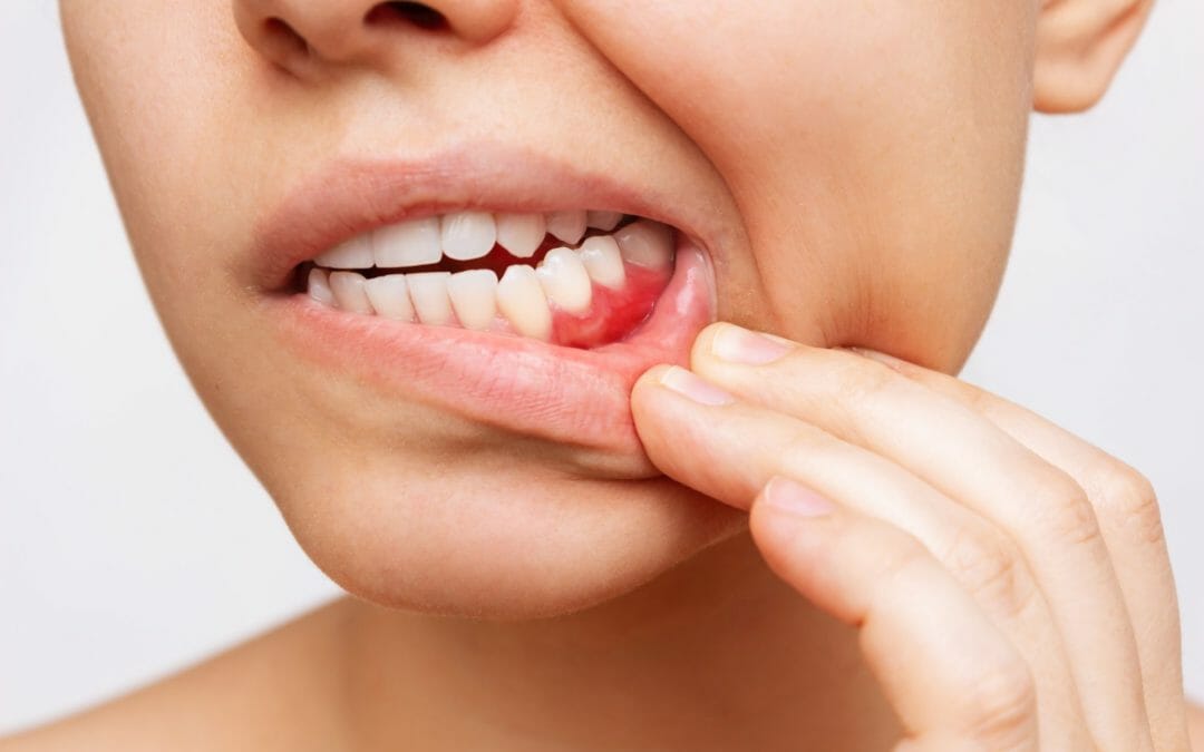How Untreated Gum Disease May Affect Your Overall Health