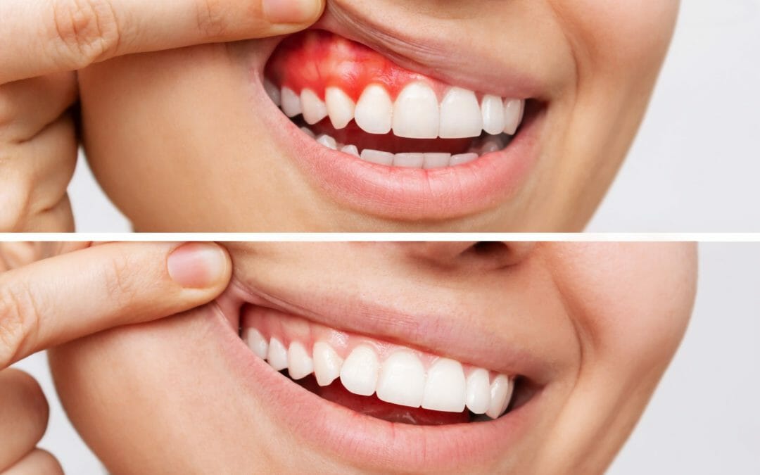 inflamed gums and healthy gums