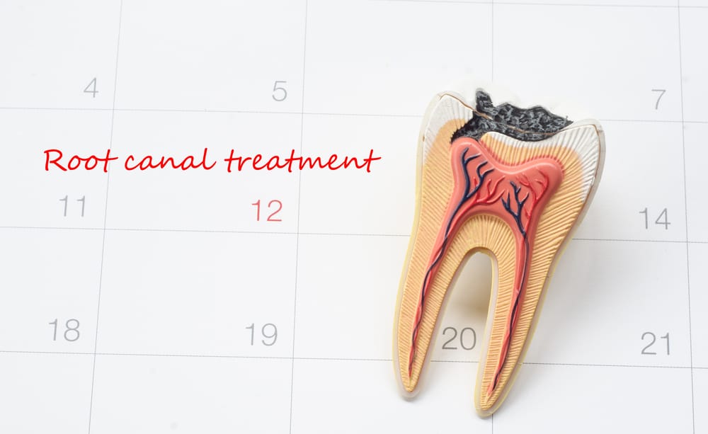 root canal schedule
