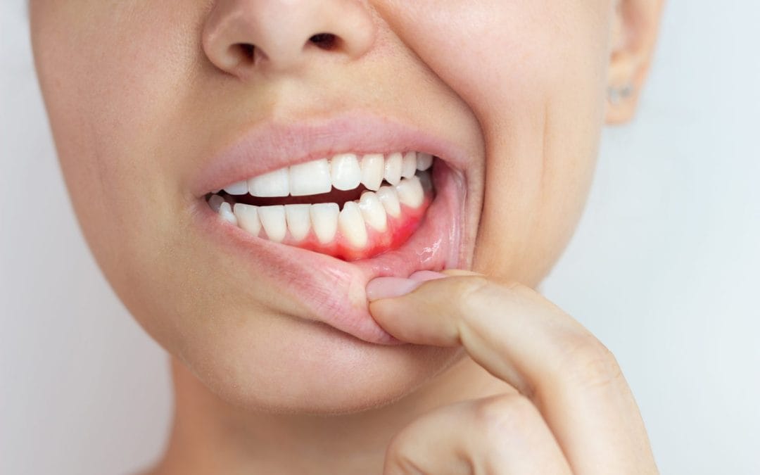 How Diabetes and Gum Disease Feed Each Other