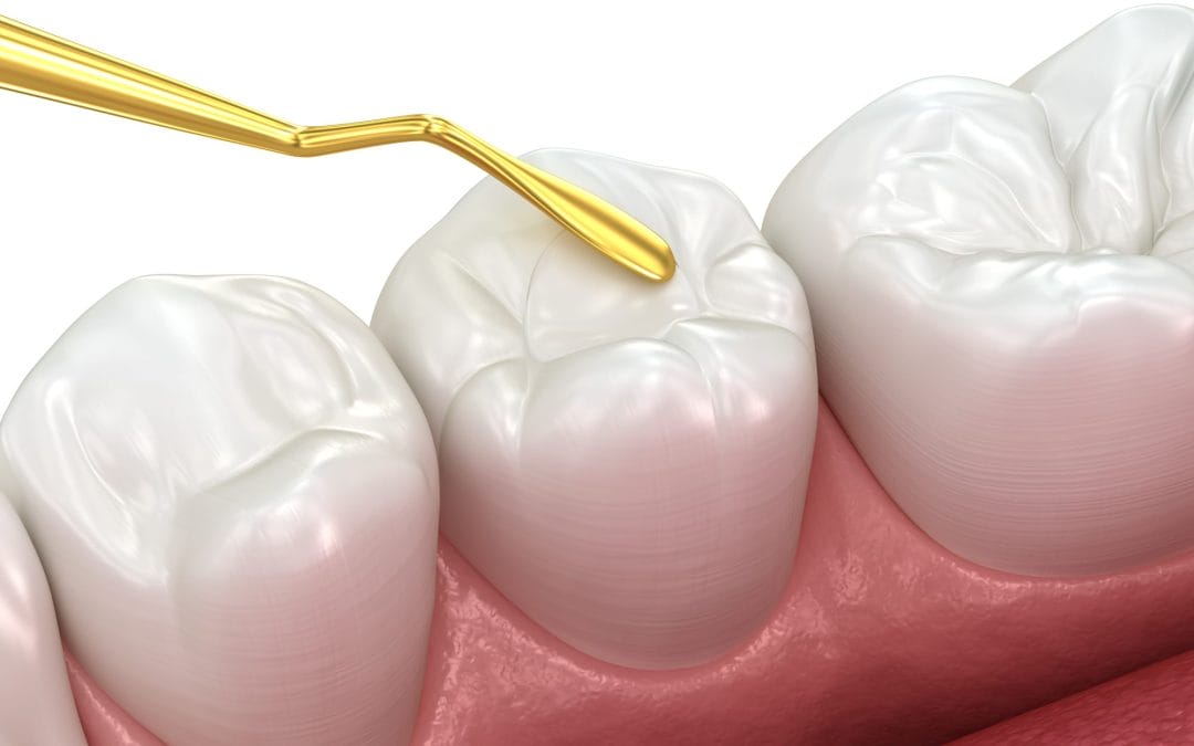The Benefits of Dental Sealants for Kids