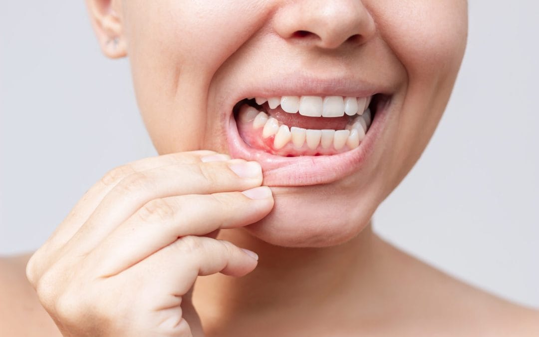 What Your Gums Are Telling You: Early Signs of Gum Disease