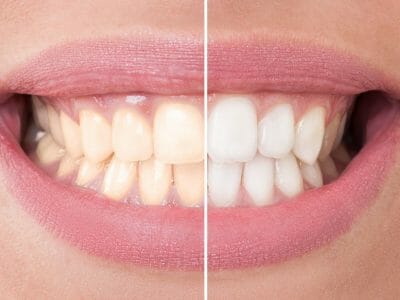 before and after of teeth whitening