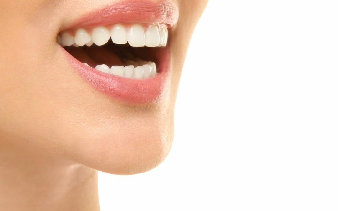 5 Benefits of Dental Bonding