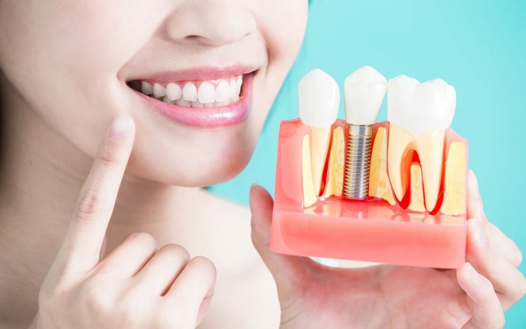 The Difference Between a Dental Bridge and Dental Implants