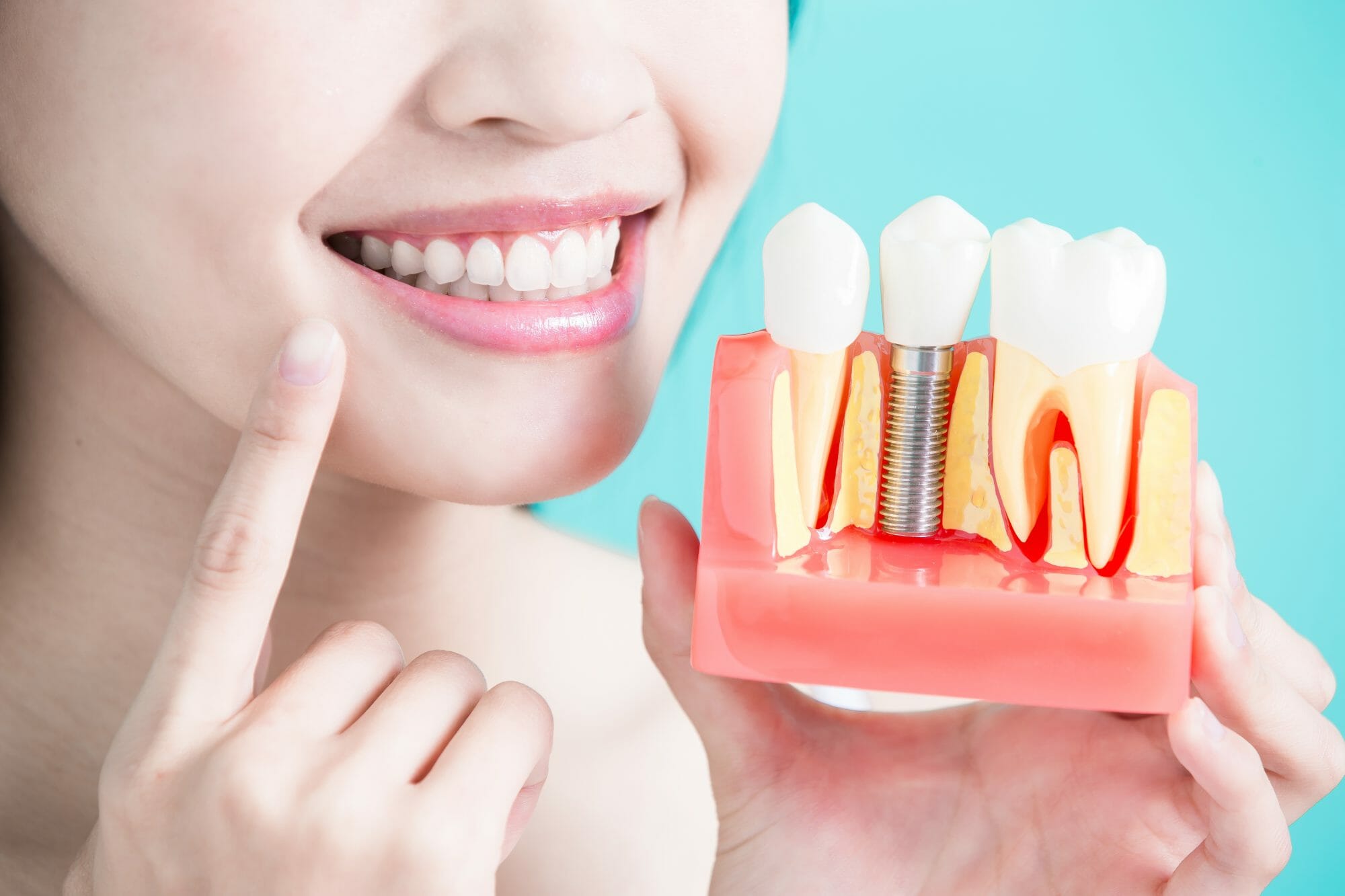 Learn The Difference Between a Dental Bridge & Dental Implants