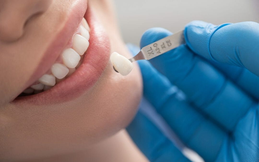 The Importance of Dental Crown Maintenance
