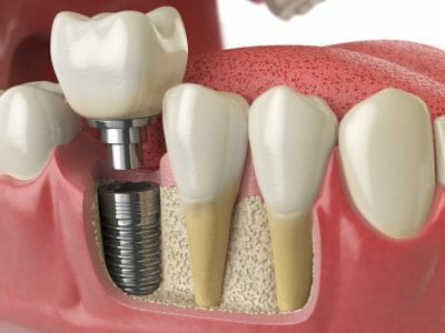 showing the different components of a dental implant