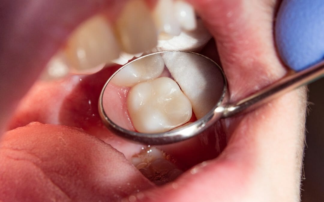 Composite vs. Amalgam Fillings: Which One Is Right for You?