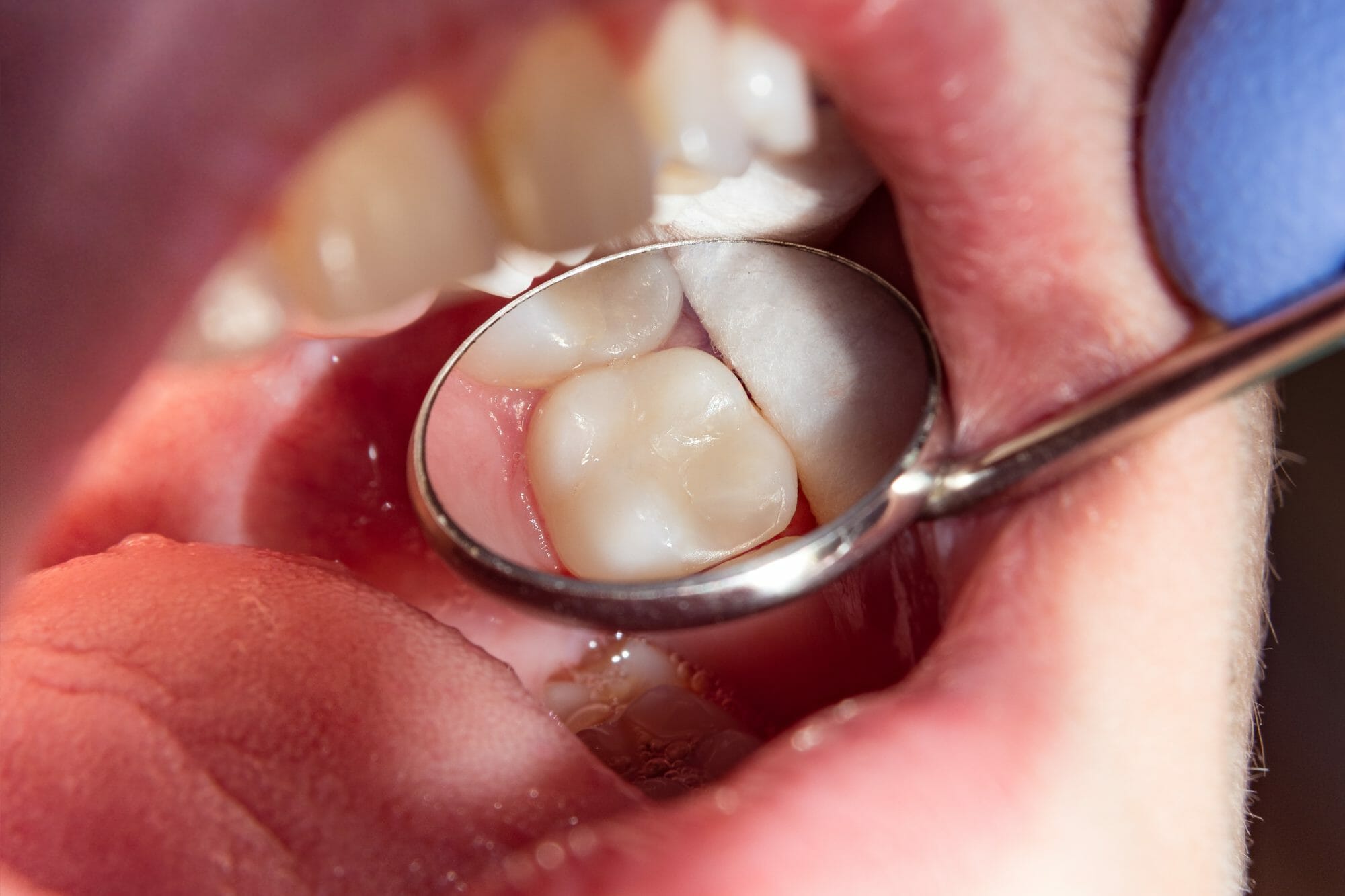 Can a Tooth With A Filling Get a Cavity? - Family Tree Dental