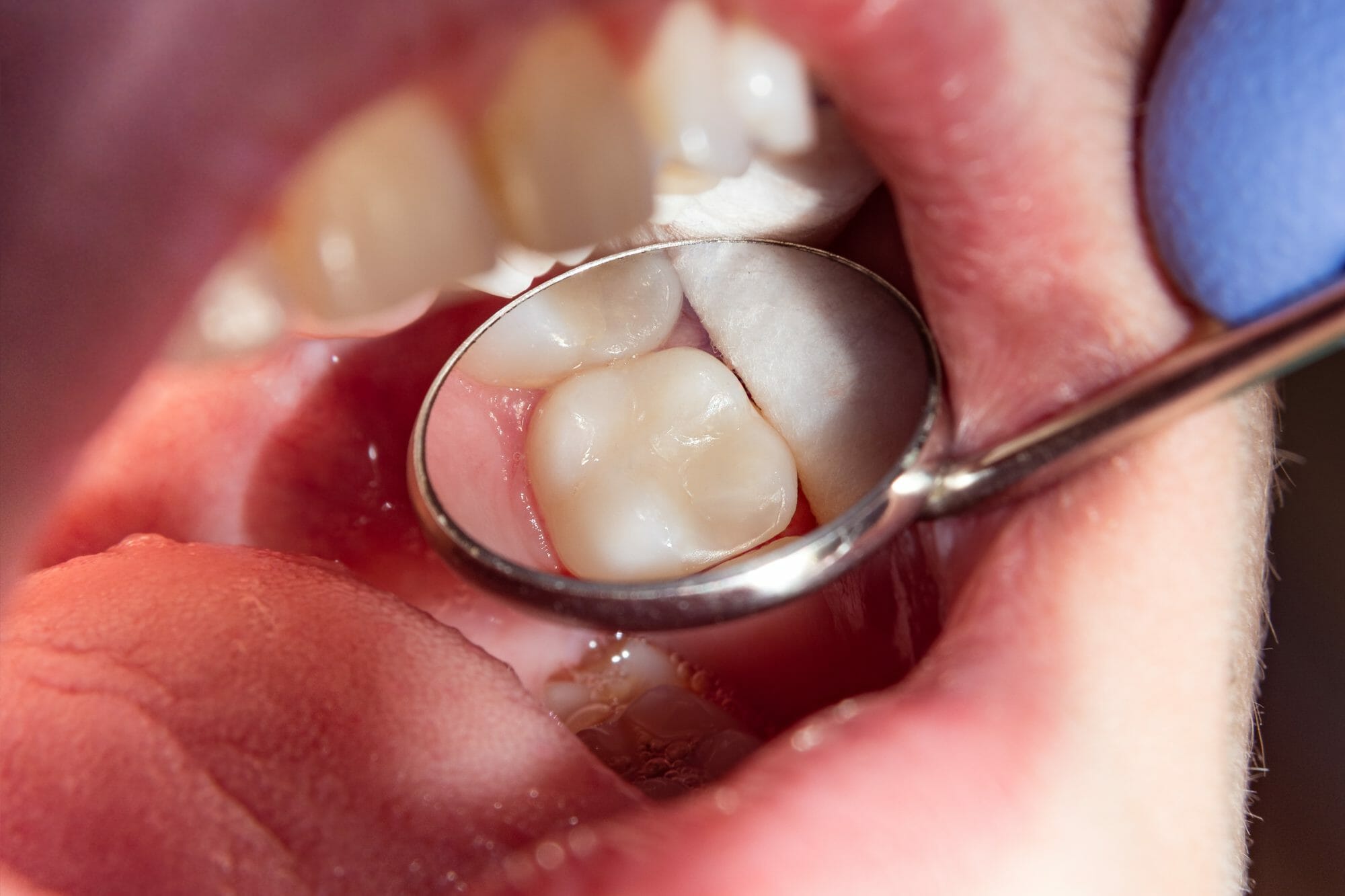 Composite VS Silver Fillings