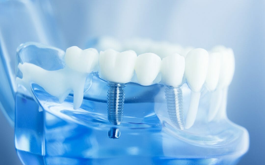 The Benefits of Dental Implants