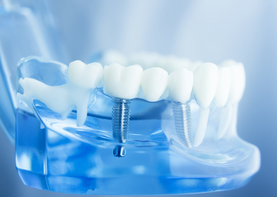 The Benefits of Dental Implants Dentistry of West Bend