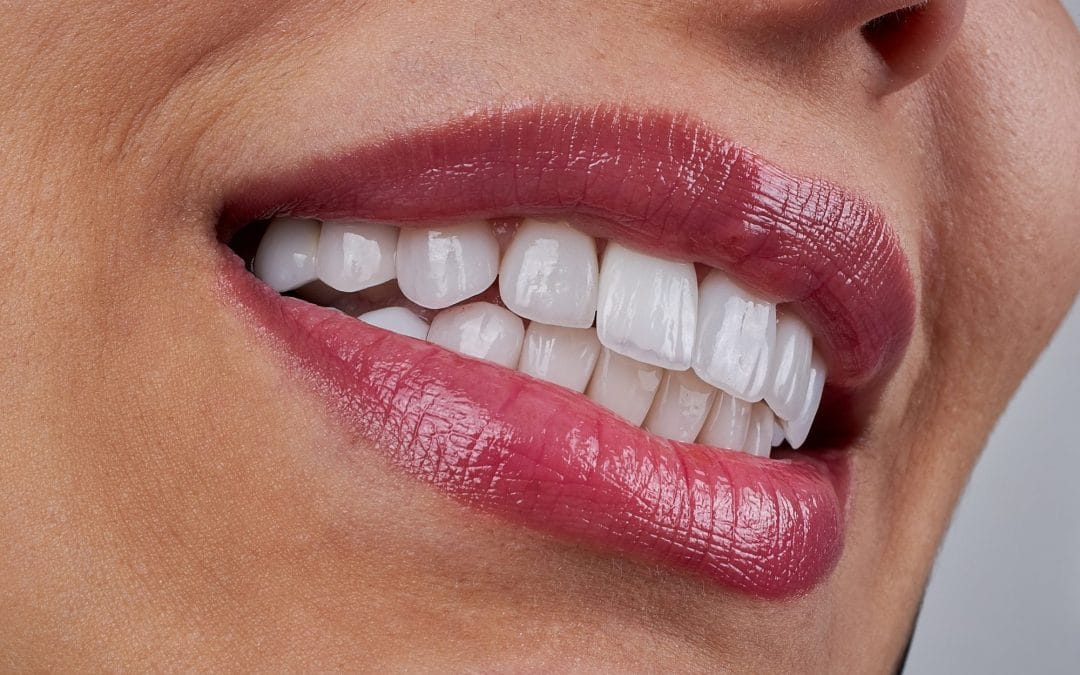 Bonding vs Veneers: Your Guide to Small Tooth Fixes